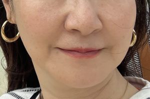 アンチエイジング体験記の画像